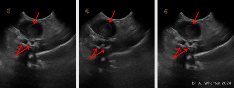 utz ovarian abscess