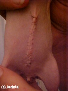 abd sutures
