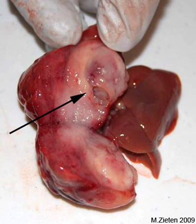 Tape worm cyst liver mass