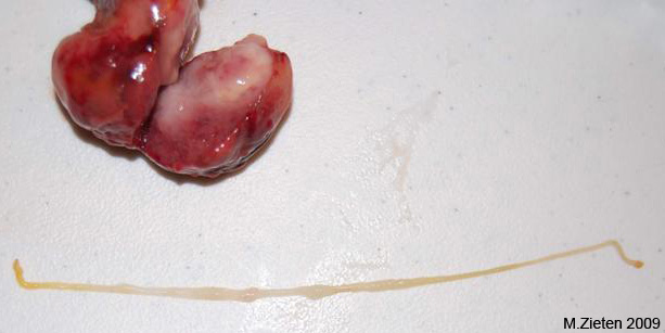 Tape worm cyst liver mass