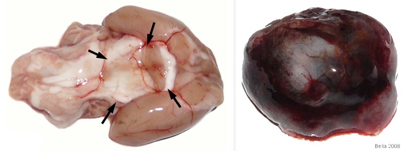 Pituitary tumor