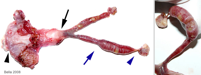 vaginal sarcoma