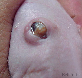 squamous neoplasia of eye