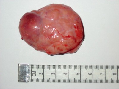 tumor